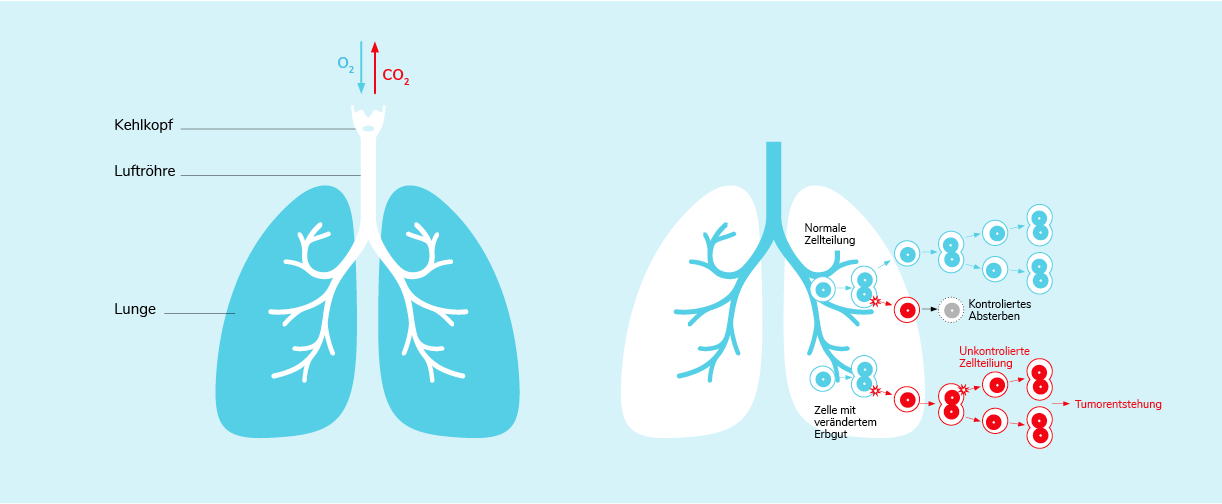 01-01-Was-ist-Lungenkrebs-Section-10.png 01-01-Was-ist-Lungenkrebs-Section-10.png