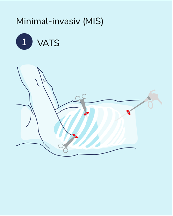 lungenkrebs_hub.behandlung.operation.2024.acc3.1.png lungenkrebs_hub.behandlung.operation.2024.acc3.1.png