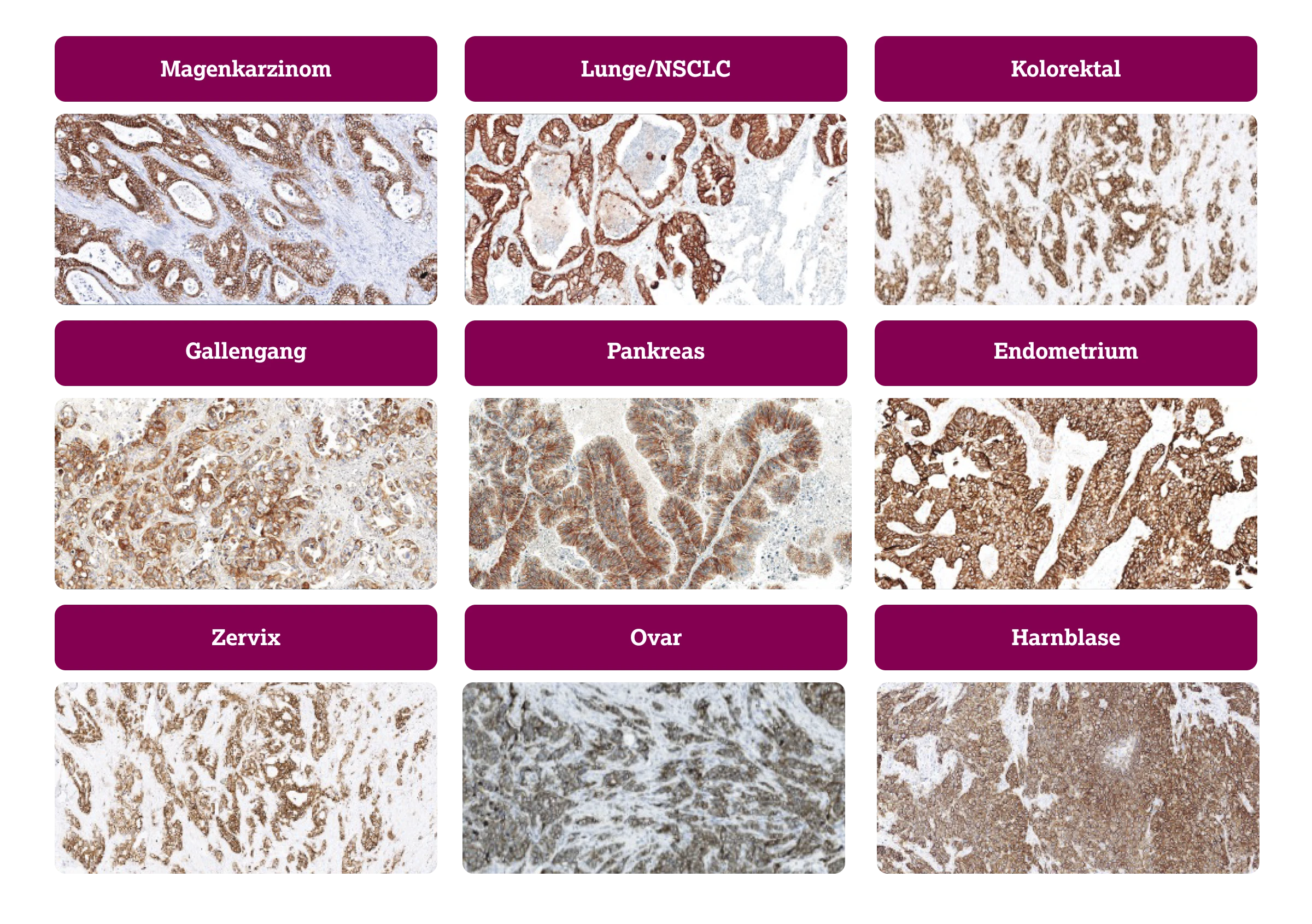 5.3.2-01-IHC-3gema-ASCO-ASCP-CAP.webp 5.3.2-01-IHC-3gema-ASCO-ASCP-CAP.webp